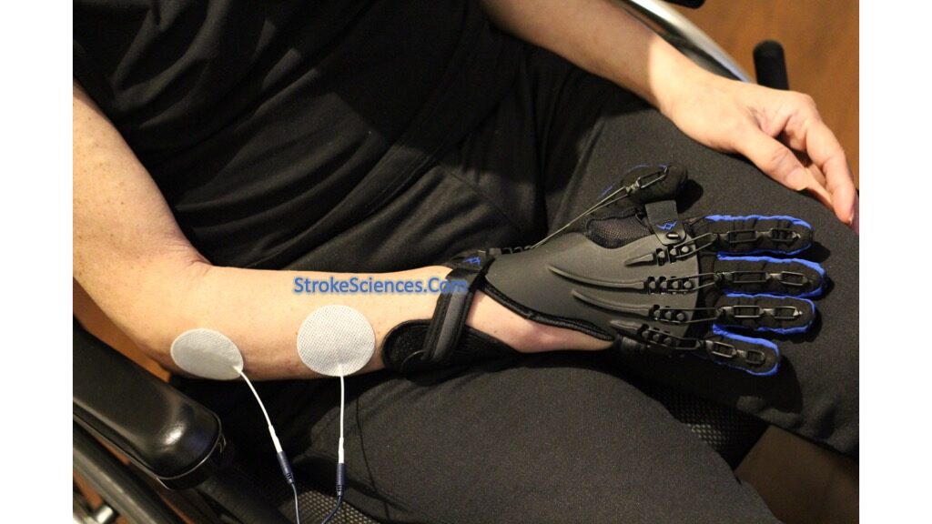 electrical-stimulation-for-hypertonicity-a-neurorehabilitation