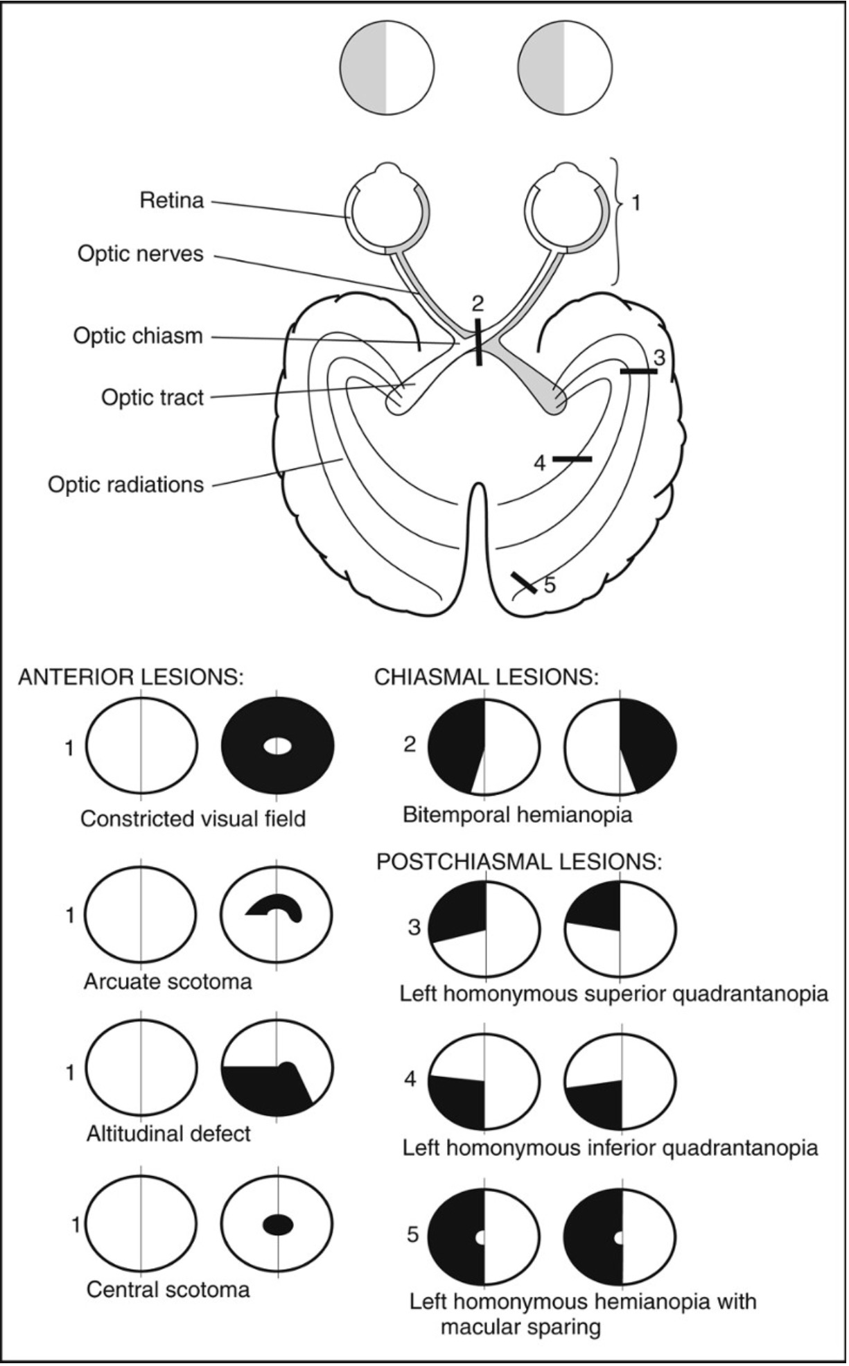 Stroke Visual Field