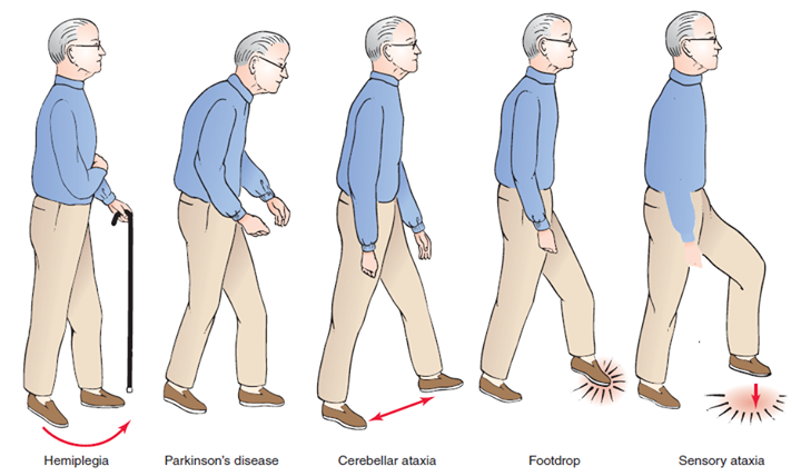 Neuro Exam Post Stroke Hemiplegic Gait StrokeSciences