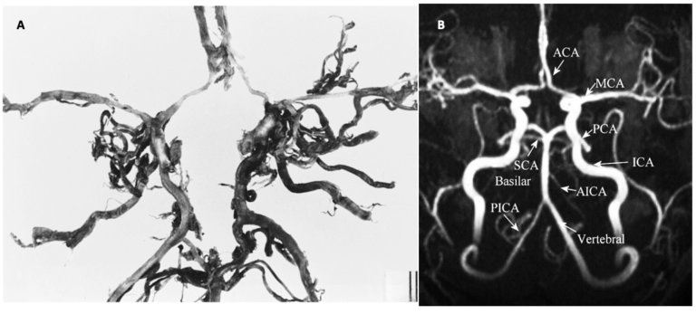 Will the Circle Be Unbroken: Implication of a complete Circle of Willis ...